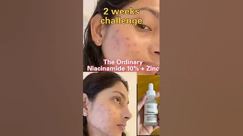 The ordinary niachinamide 10% + zinc 1% true review for dark sports and acne #shorts #viral #youtube