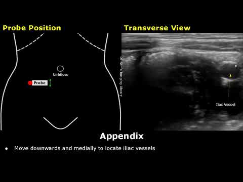 How To Scan Appendix | Ultrasound Probe Positioning | Transducer Placement | Abdominal USG Scanning