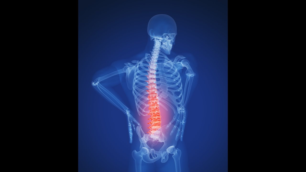 Pilates help for degenerative disc problems YouTube