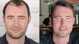 Dr.Erkan Demirsoy 3850  Grafts Fue Before After Photos#hairtransplantbeforeafter #beforeandafter