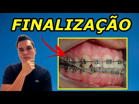 Vídeo: A fase final do tratamento no dentista