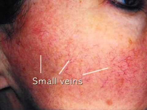 vascular lesions - YouTube