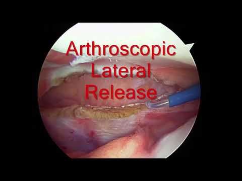 Arthroscopic Lateral Release Procedure