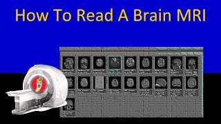 How To Read A Brain MRI - Neuroradiology Made Easy (Maybe?)