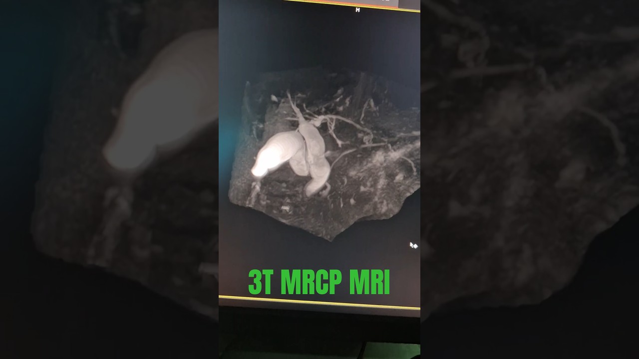MRCP 3D BILE DUCT MRI 3T 3TESLA MRI  