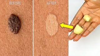 PLACE 1 ON SKIN TAG EVERY-NIGHT QUICK TREATMENT FOR SKIN TAG