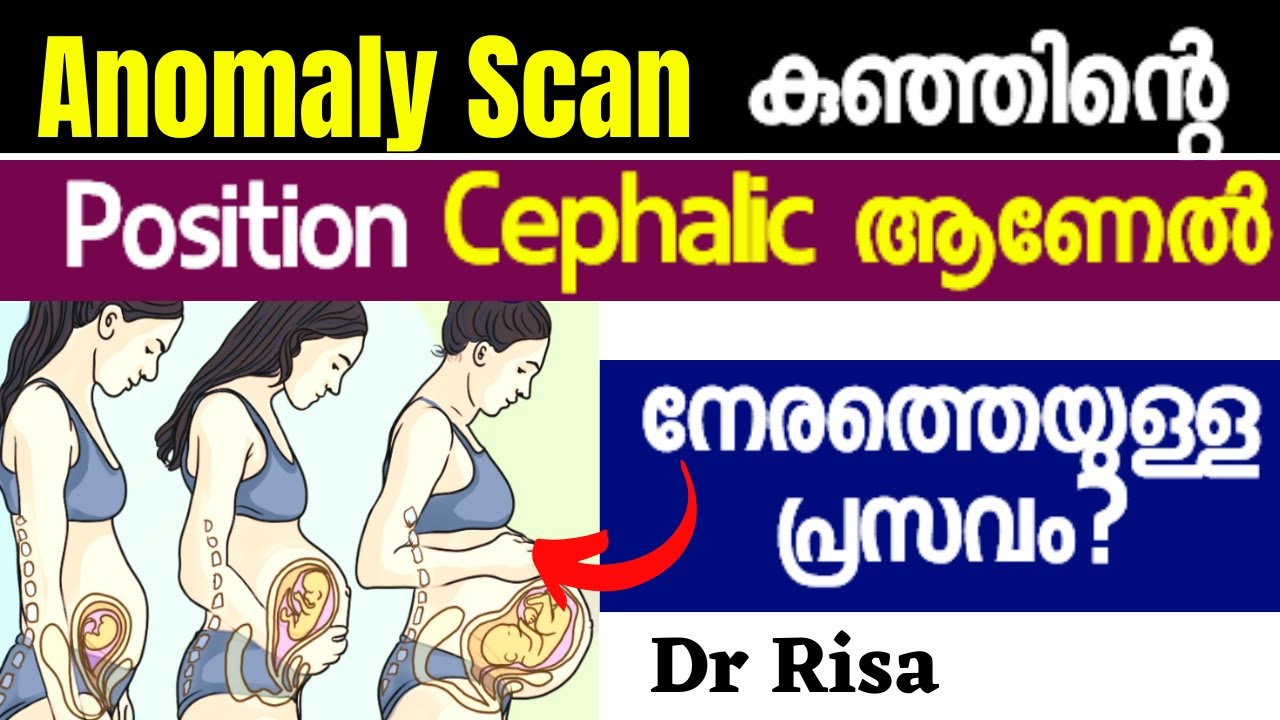 cephalic presentation meaning in malayalam