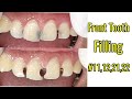 Front tooth filling 11122122