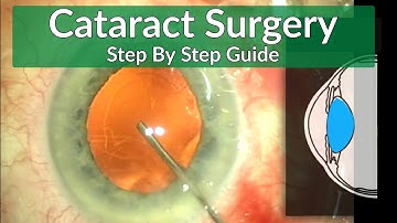Cataract Surgery Teaching - A Beginner