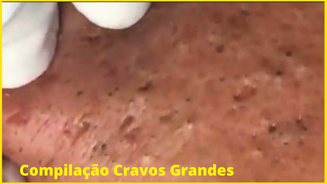 Extração de Acne Compilação de Remoção de Cravos Grandes - YouTube