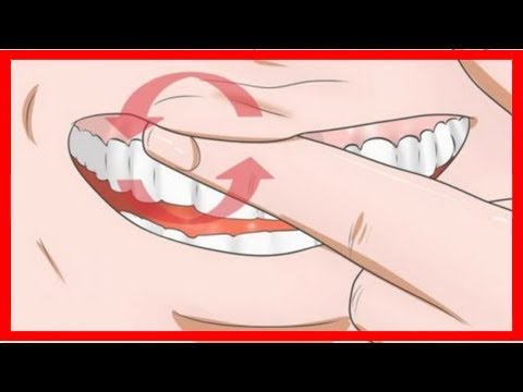 Video: Zahnfleischrückgang verhindern – wikiHow
