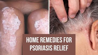 🆘 Home Remedies for Psoriasis Relief