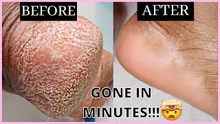 HOW TO REMOVE DEAD SKIN CELLS FROM YOUR FEET IN MINUTES | Self Care Routine screenshot 3