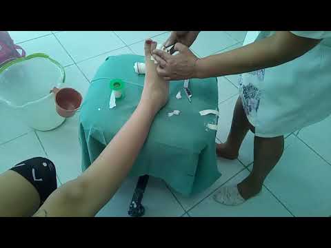 Vídeo: 3 maneiras fáceis de curar uma lesão no dedo do pé