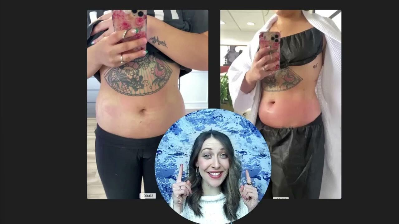 How long does swelling last after CoolSculpting? Element Body Lab