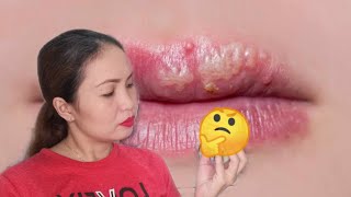 PINAKAMABISANG GAMOT SA HERPES (Cold Sore) || Cold Sore  Causes, Prevention and Cure || Teacher Weng screenshot 4