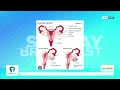 Ovarian Cysts Explained: Causes, Symptoms & When to Seek Help | Sunday Breakfast