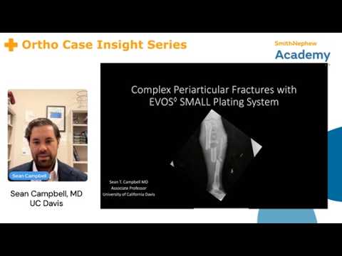 Ortho Case Insight Series |Complex Periarticular Fracture Management with EVOS◊ SMALL Plating System