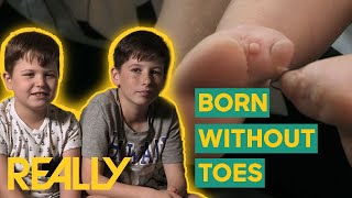 Boys Born Without Toes Get Custom-Made Prosthetic Feet! | Body Bizarre