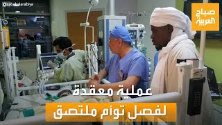 صباح العربية| عملية معقدة لفصل توأم ملتصق في السودان