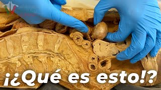 Top 5 COSAS LOCAS encontradas en cuerpos humanos