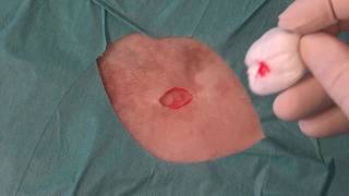 Nevus removal