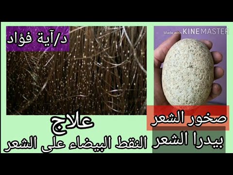 علاج بيدرا الشعر النقط البيضاء والسوداء على الشعر مرض لم يتحدث عنه أحد على اليوتيوب 