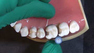 Uses for the Deep Margin Elevation Kit from Garrison with Dr. JD Corey