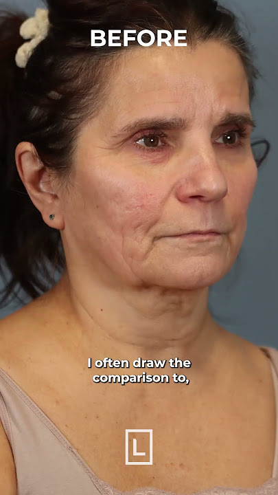 Download lagu What Is a SMAS Facelift? | Part 1 with Dr. Leong