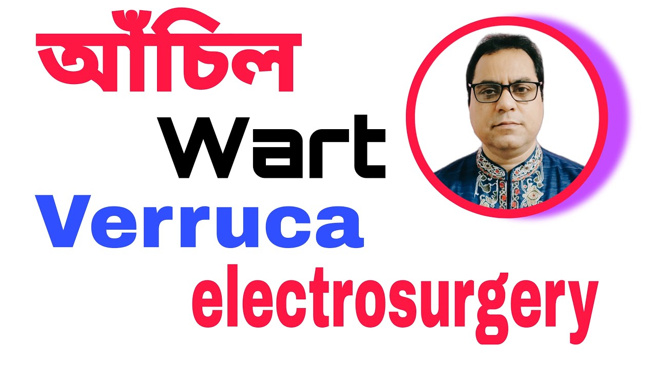  আঁচিল হাত ও পায়ের আঁচিল laser treatment laserelectrosurgery dermatosurgery cryosurgery