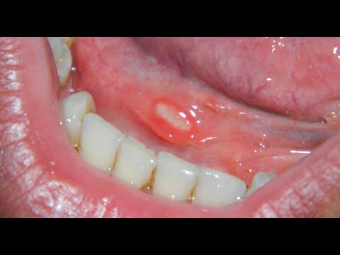 Dermatoloq / Ağızda yara / Behçet xəstəliyi / Oral aftoz stomatit