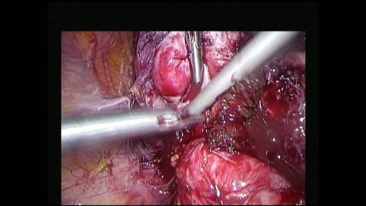 Advanced endometriosis