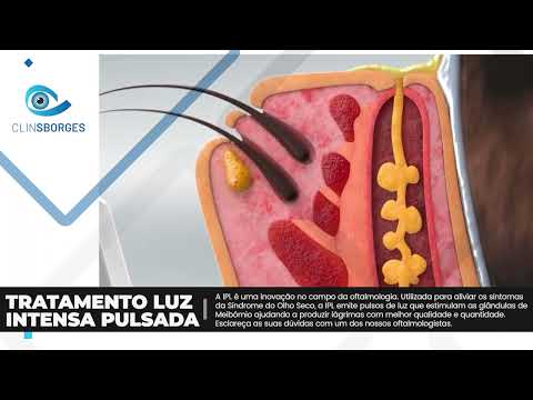 CLINSBORGES - TRATAMENTO DA LUZ INTENSA PULSADA