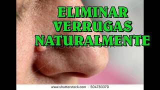 2 MANERAS DE ELIMINAR TUS VERRUGAS NATURALMENTE