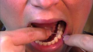 The correct use of dental floss