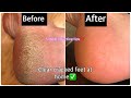 How to remove dead skin cells from your feet | get soft smooth feet at home