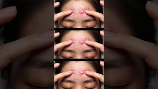 Please tell medicine for this l Pimple ASMR on Face | Satisfying Popping & Skincare Sounds