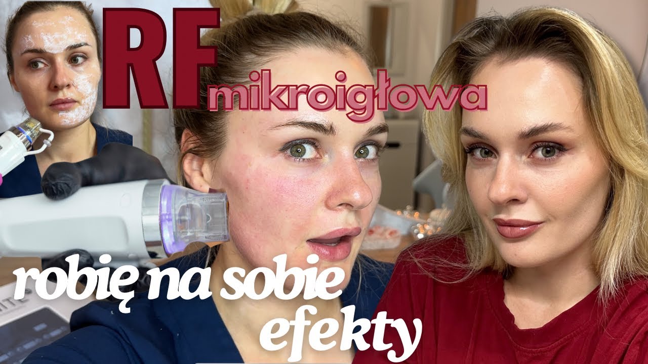 Zrobiłam sobie RF mikroigłową!😍 Musisz zobaczyć efekty!🔥