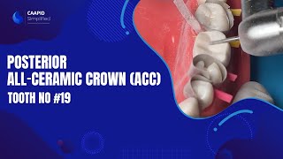 Posterior AllCeramic Crown (ACC) on tooth no #19 | Full Course on Link Below