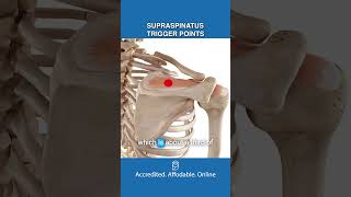 Are Supraspinatus Trigger Points Causing Your Arm Pain?