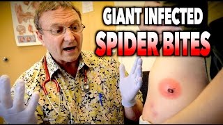 GIANT INFECTED SPIDER BITES! | Dr. Paul