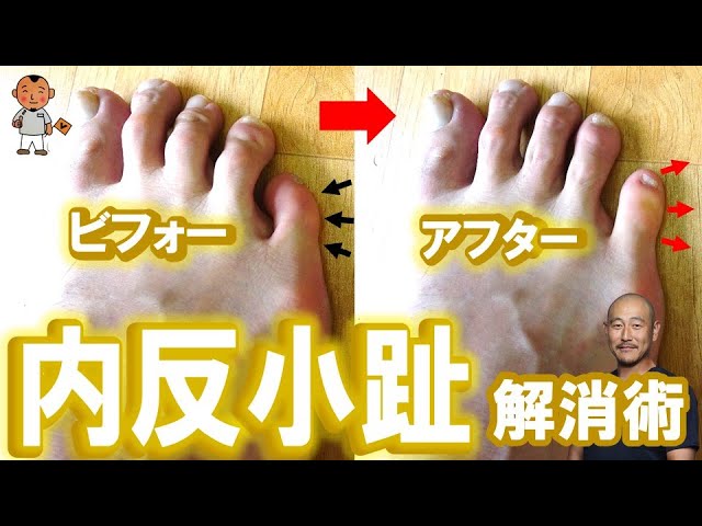 内反小趾 内側に入っている小指を広げる運動 川崎市の外反母趾治療家 バイタルあきやま Youtube 内反小趾 内側に入っている小指を広げる運動 川崎市の外反母趾治療家 バイタルあきやま Youtube
