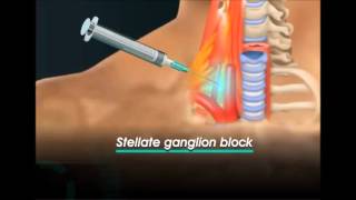 stellate ganglion block