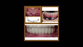 All-on Implant Restorations