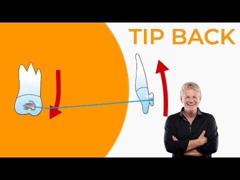 EFFECTIVE Orthodontic Tools - TIP BACK for beginners - @csorthoschool