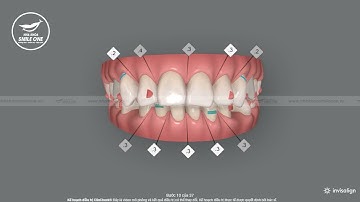 Clincheck 3D dự đoán trước kết quả niềng răng
