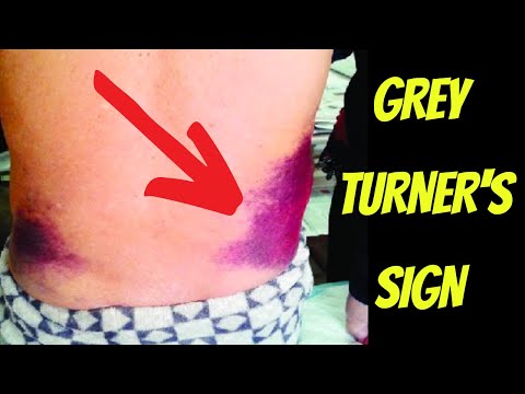 Grey Turner&rsquo;s Sign & Retroperitoneal Haemorrhage Explained | Doctor O&rsquo;Donovan