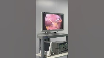 Thao tác cắt túi mật #Soithan #tansoithan  #bacsitung #pcnl #aroretic #akicare #soinieuquan