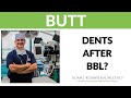 Plastic Surgery Truths: Dents After a BBL