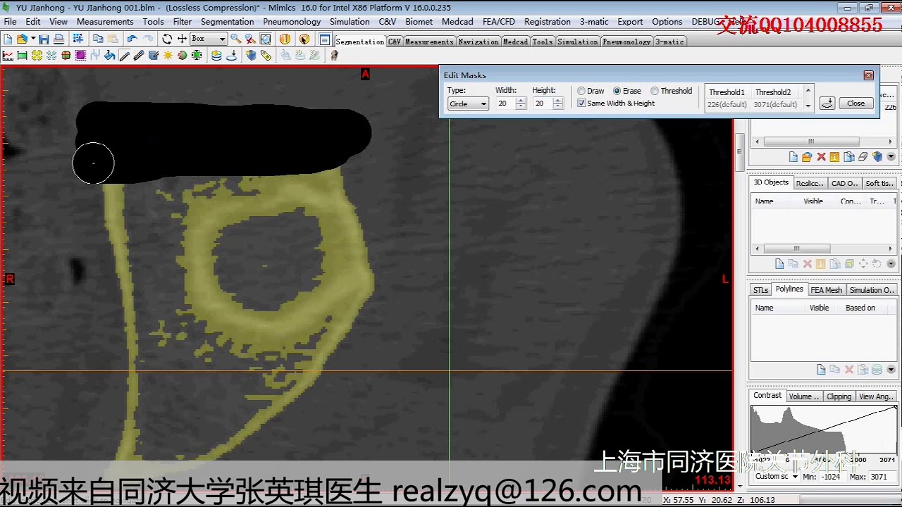 mimics中文视频教程 003 蒙版分割骨块建模 - YouTube